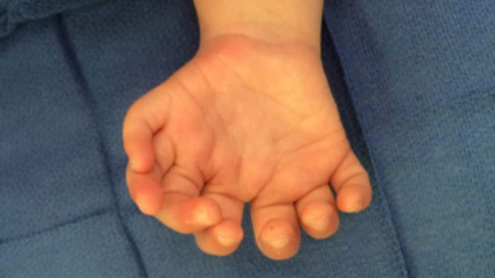 Rare disorders of the back of extra fingers and toes: study  health news