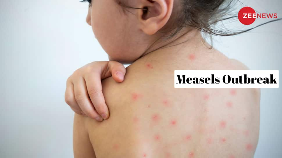 Measles Outbreaks: Understanding Symptoms, Prevention and Treatment  health news